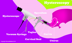 Hysteroscopy at Fertility Center Basrah - Infertility Clinic 